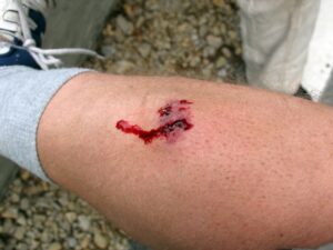 bigstock Dog Bite Wound 80320697 gsji4u scaled